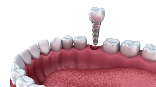 种植牙一颗600能种吗？不建议种，揭秘种牙价格套路