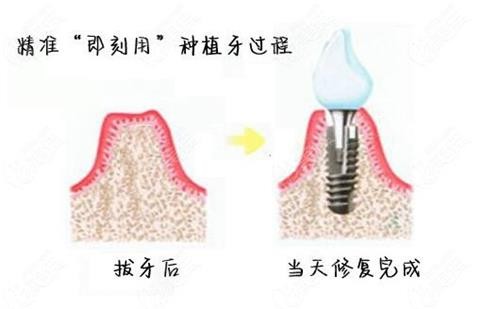 种植牙会越来越便宜吗？目前不会，价格伴随材质等浮动