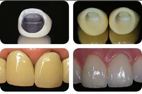 2024国内种植牙牙冠价格表：烤瓷冠800+/全瓷冠2000+/树脂冠仅适合短期过渡500+！