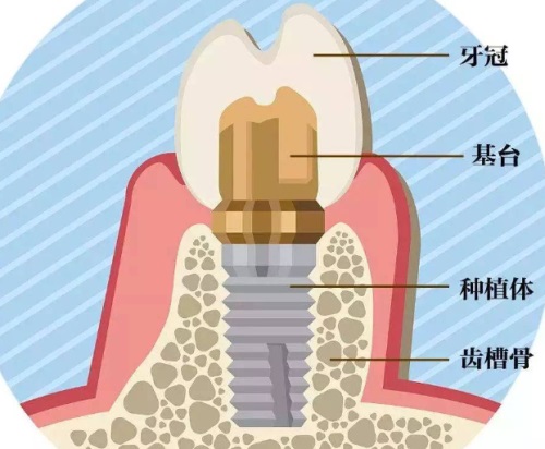 长沙种植牙多少钱一颗，2024长沙种植牙价格表大全分享给大家！