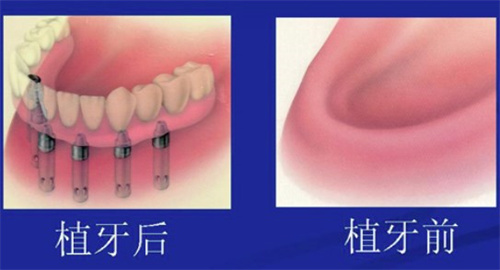 重庆牙博士口腔医院种植牙可靠吗？看看这份价目表与用户评价，了解急诊24小时服务！