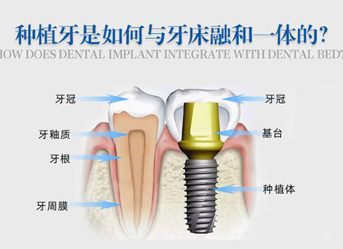种植牙和牙床关系图展示