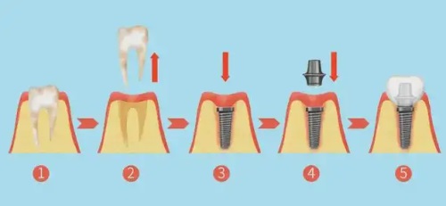种植牙过程图片