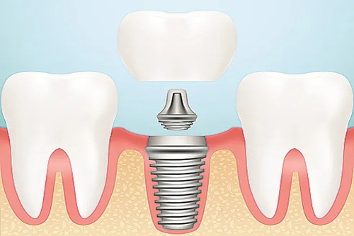 种植牙对口腔牙齿有危害吗？科普关于种植牙的利弊！