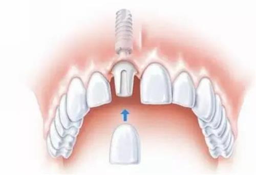 种植牙的种植部位