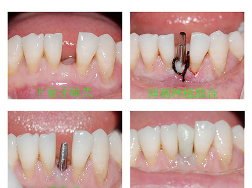 哈尔滨团圆口腔医院种植牙价格多钱？国产2100+