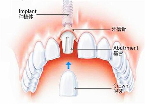 医院做种植牙一颗多少钱 整理种植牙价格表!