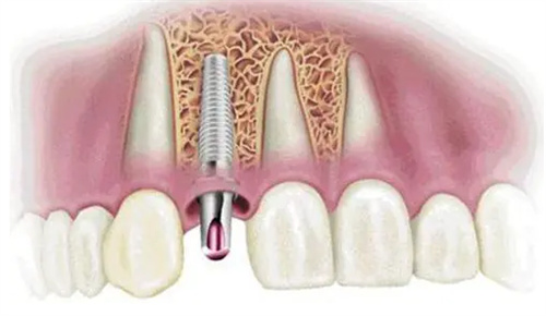 江津区牙科医院种植牙多少钱一颗?价格表免费拿走