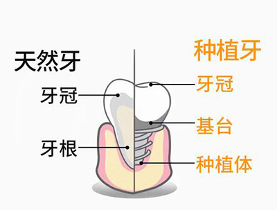 真实牙和种植牙对比卡通图