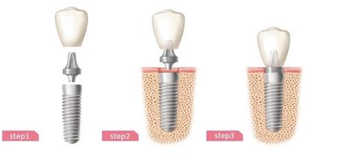 种植牙的步骤。