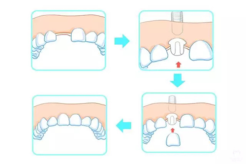 种植牙过程卡通示意图