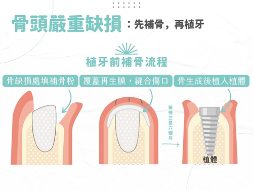 种植牙植骨与植体植入过程漫画图