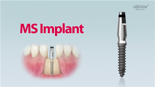 奥齿泰植体型号有哪些?请看5款植体介绍及价格解析!