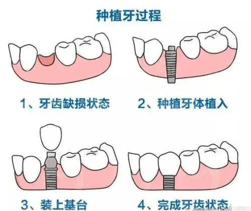 种植牙过程示意图