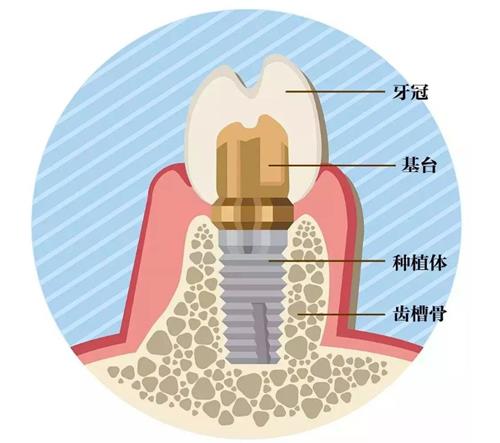 正规医院种植牙收费标准!植体,基台,牙冠均有介绍~