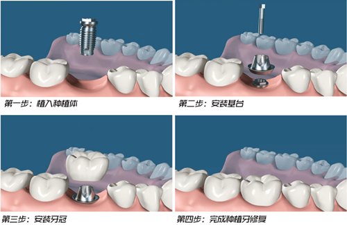 种植牙过程图示