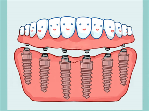 All-On-6全口种植牙漫画图