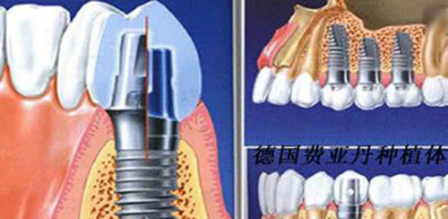 德国种植体示意图