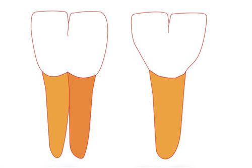 双生牙是什么？为什么会出现双生牙？处理措施速看！