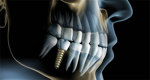 英博口腔种植牙价格曝光，多少钱一颗看完便知~