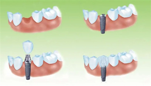 种植牙过程
