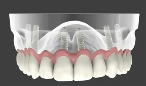 探秘:全口种牙是分段桥好还是整体桥好？