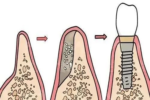 先植骨再种牙过程示意图