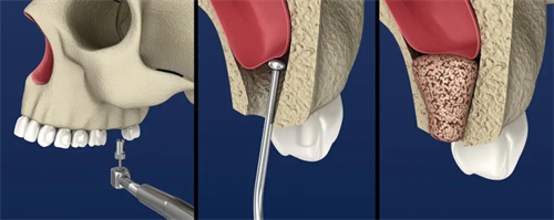 上颌窦提升手术示意图