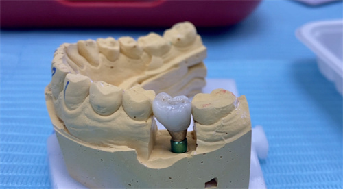 种植牙一体冠