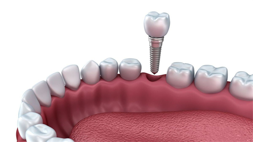 武汉海峡明朗口腔种植牙价格亲民:进口种植牙3k起