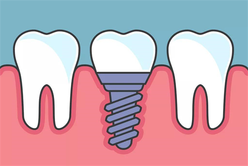 25年潍坊种植牙价格表发布：国产/进口植体价格都有