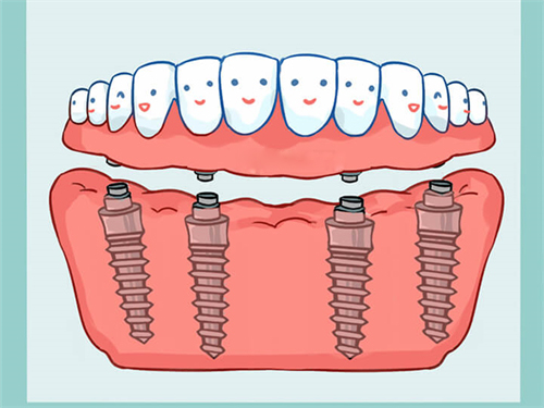 All-On-4全口种植牙漫画图