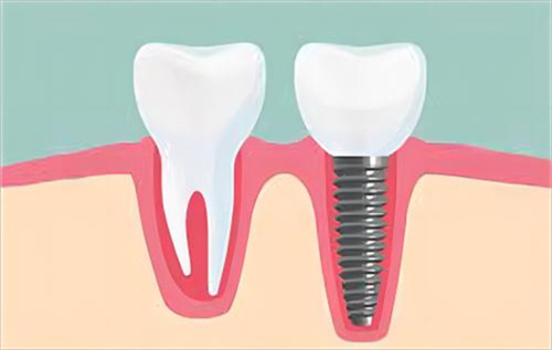2024年种植牙项目的价格表来袭！让您安心就医！