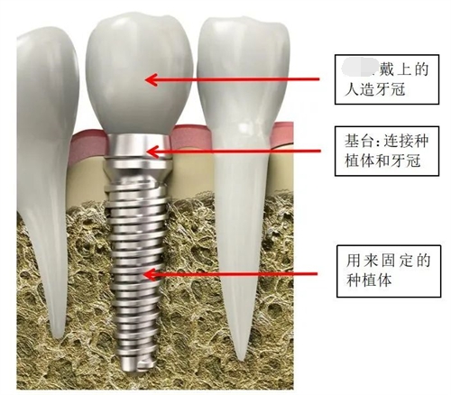 种植牙结构讲解漫画图