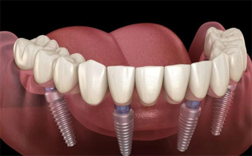 全口种植六个植体和四个植体哪个好?我们该如何选择