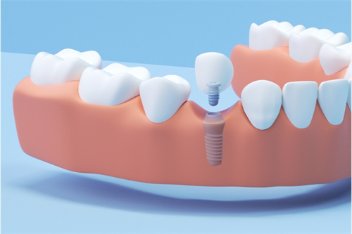 种植牙模型展示图