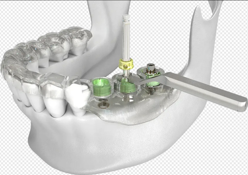 安装种植牙示意图
