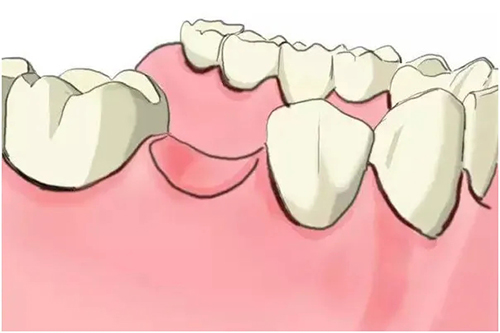 缺牙卡通示意图