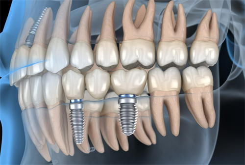 种植牙的质量哪种好?5款热门植体品牌对比选择指南!