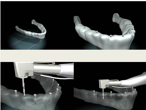 种植牙模拟步骤图