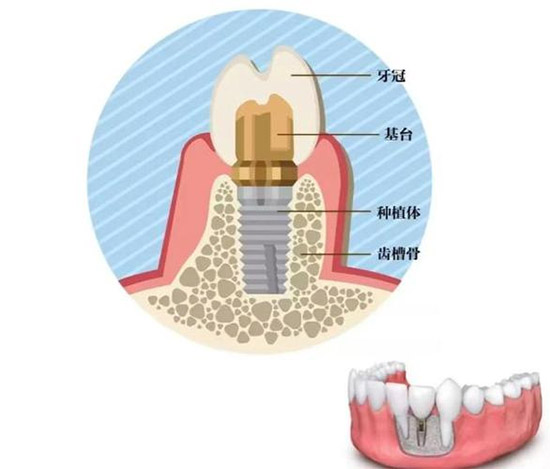 钛锆和瑞锆种植体区别分析!PK看哪个好~