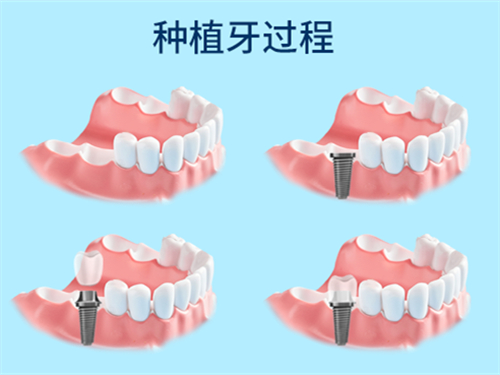 杭州种植牙多少钱一颗2024年?单颗|半口|全口价格分享