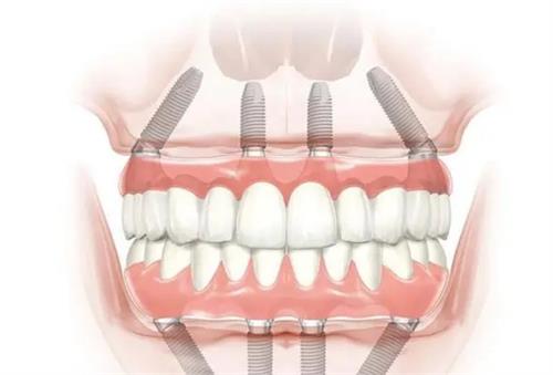 全口种植牙的示意图