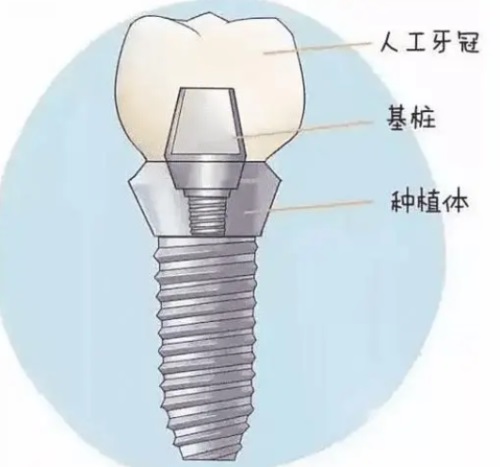南京种植牙价格表大全！附各个植体品牌收费