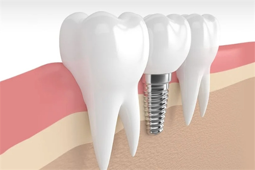 种植牙模型示意图