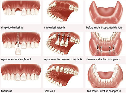 缺失牙齿进行种植牙