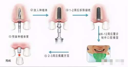 种植牙的6个步骤图解