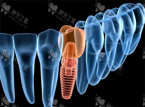 单颗种植牙演示图