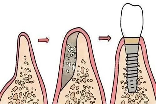 种植牙骨质疏松后会掉吗？可能会！