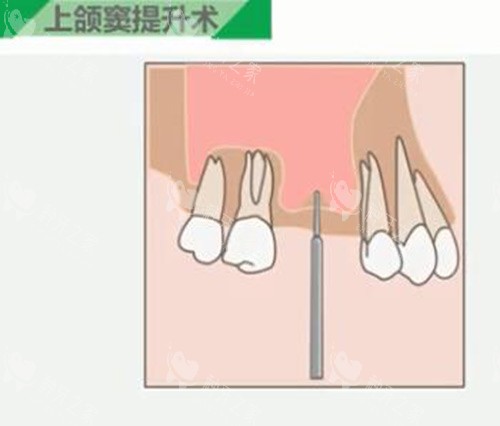 上颌窦提升步骤